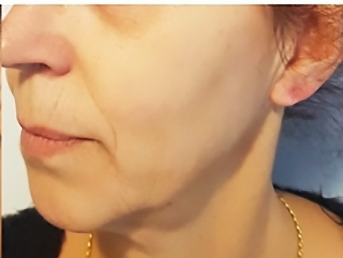 Rostro después del tratamiento de manchas